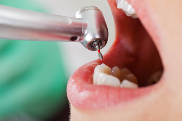 Best Emergency Tooth Extraction in Fitchburg, WI